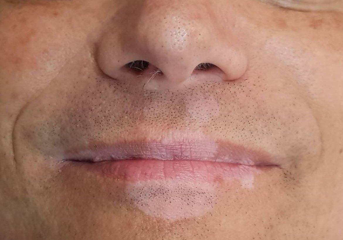 Antes da camuflagem estética para vitiligo — contorno dos lábios