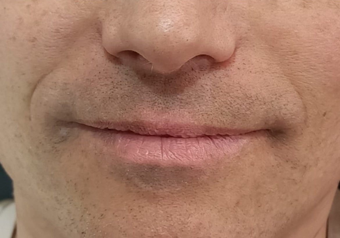 Depois da camuflagem estética para vitiligo — contorno dos lábios