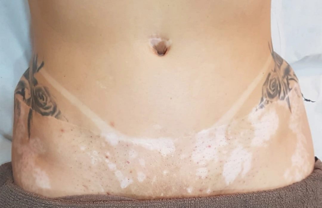 Antes da camuflagem estética para vitiligo — abdômen e virilha