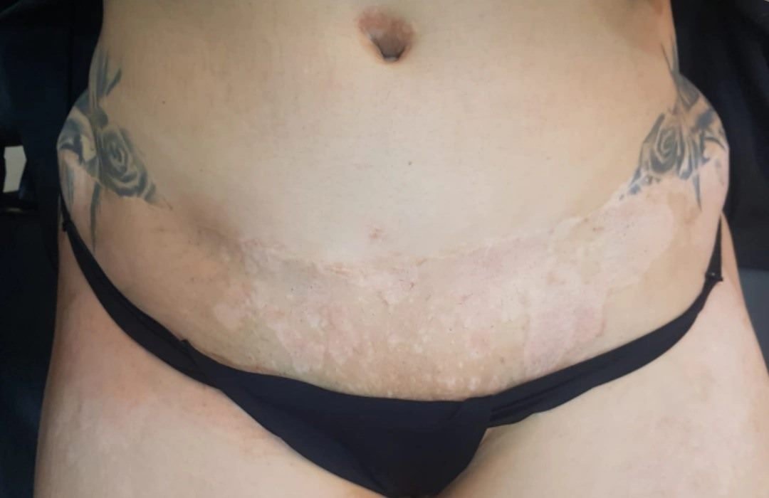 Depois da camuflagem estética para vitiligo — abdômen e virilha