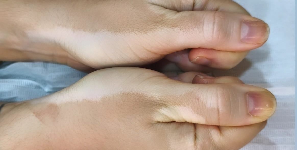 Antes da camuflagem estética para vitiligo — dorso das mãos