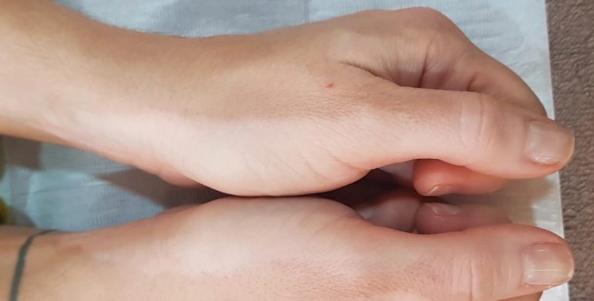 Depois da camuflagem estética para vitiligo — dorso das mãos