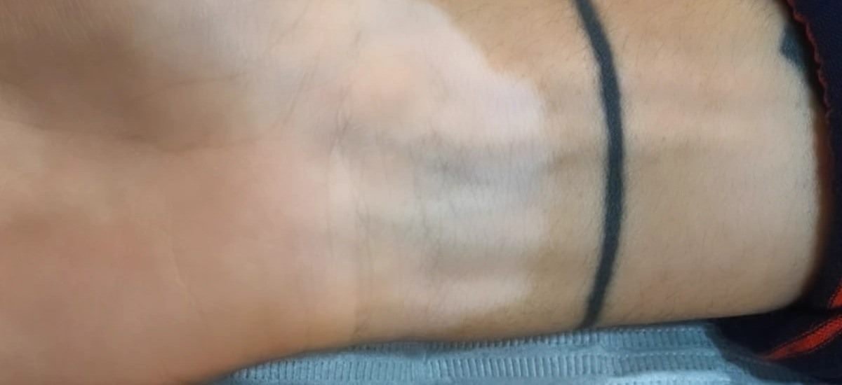Antes da camuflagem estética para vitiligo — punho