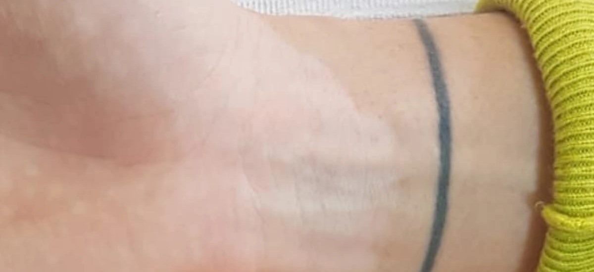 Depois da camuflagem estética para vitiligo — punho