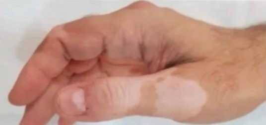 Antes da camuflagem estética para vitiligo — mão e polegar