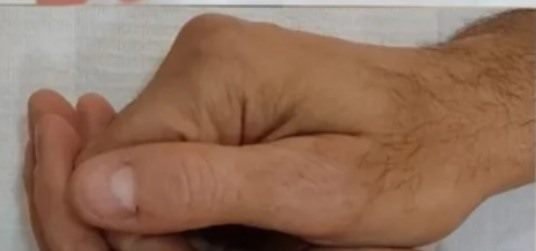 Depois da camuflagem estética para vitiligo — mão e polegar