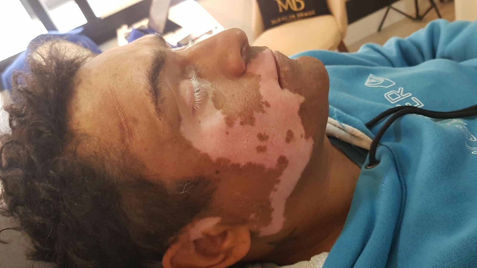 Antes da camuflagem estética para vitiligo — rosto e mandíbula