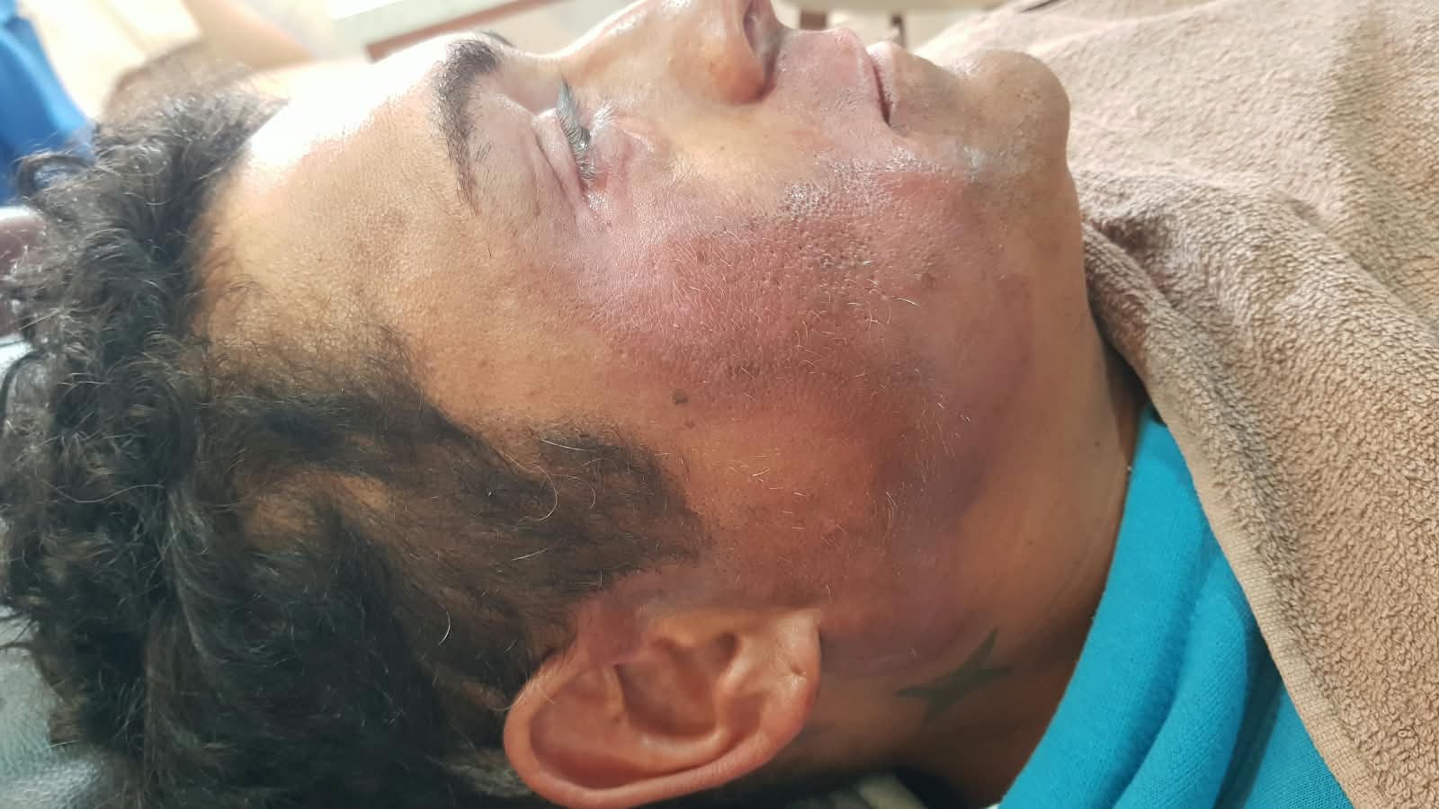 Depois da camuflagem estética para vitiligo — rosto e mandíbula