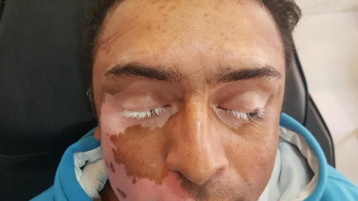 Antes da camuflagem estética para vitiligo — testa e região dos olhos