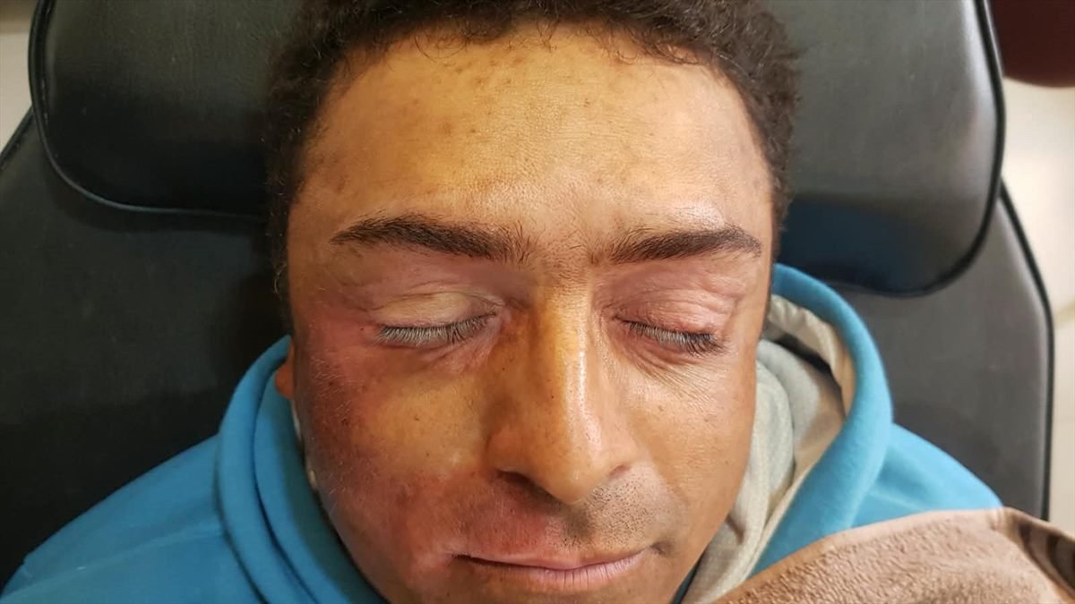 Depois da camuflagem estética para vitiligo — testa e região dos olhos